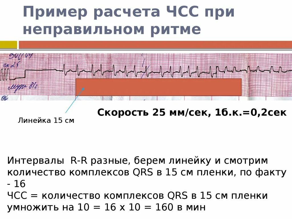 Как узнать сердцебиение. Как определить ЧСС на ЭКГ при неправильном ритме. Как определить ЧСС по ЭКГ 25 мм. Формула ЧСС по ЭКГ 25 мм. Подсчет ЧСС при неправильном ритме по ЭКГ.