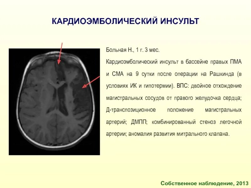 Инсульт правого бассейна. Кардиоэмболический инсульт. Кардиоэмбошическмй инсульт. Кардиоэмболический Подтип ишемического инсульта. Кардиоэмболический инфаркт мозга.