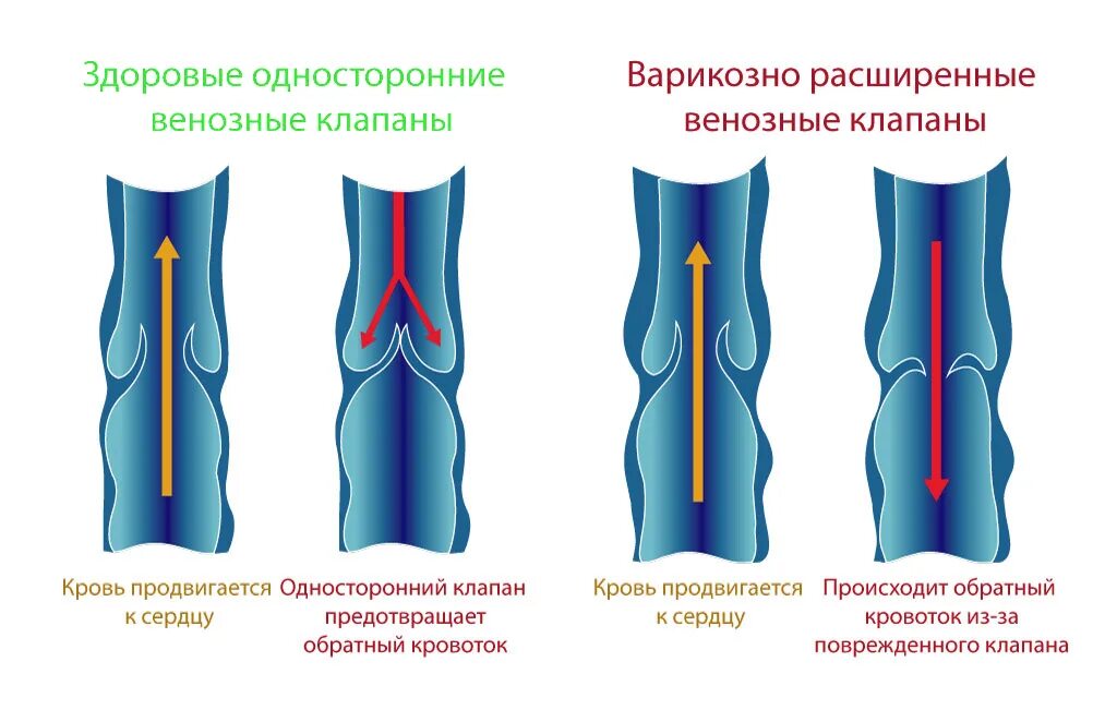 Стадии варикозного расширения вен нижних. Стадии клинического течения варикозного расширения вен. Варикозное расширение вен нижних конечностей 1 стадия. Варикозная болезнь вен этиология. Причины расширенных вен