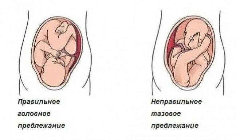 Что означает предлежание. Предлежание головное продольное на 32 неделе. Головное и тазовое предлежание плода. Позиция плода при головном предлежании. Положение плода продольное тазовое 1 позиция.