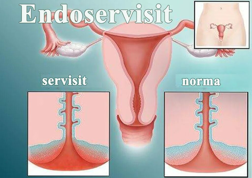 Эндоцервицит свечи. Цервицит и эндоцервицит.