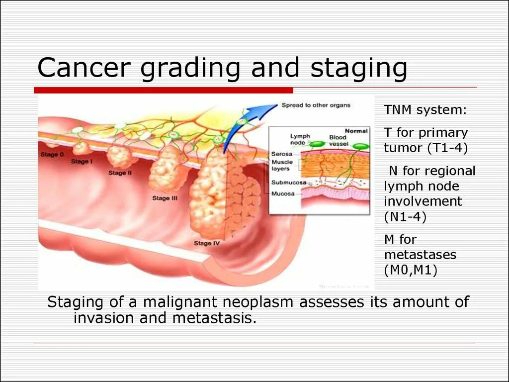 Grading (tumors). Stages of cancer