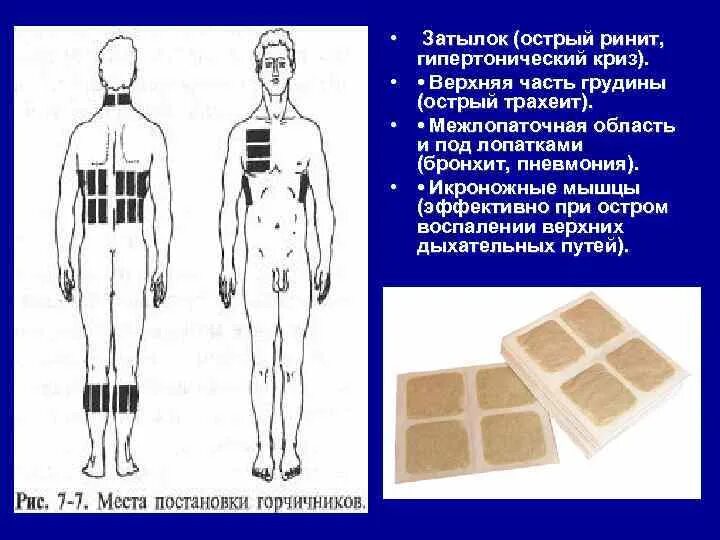 Сколько держать горчичники на спине. Места постановки горчичников. Гипертонический криз место постановки горчичников. Постановка горчичников на икроножные мышцы. Горчичники на икроножные мышцы.