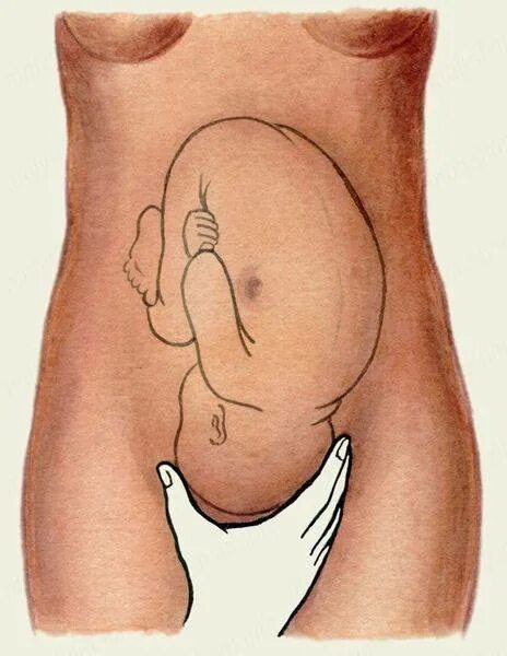 Правильное положение ребенка в животе. Поперечное ягодичное предлежание плода. Продольное головное предлежание плода. Расположение ребенка в утробе. Головное предлежание плода на 32 неделе беременности.