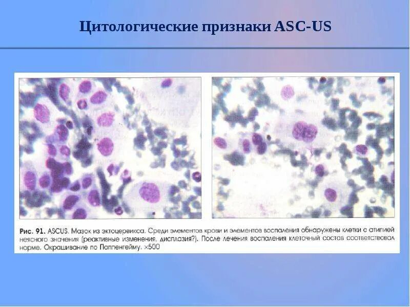 Клетки метаплазированного эпителия с реактивными изменениями. Дисплазия клеток плоского эпителия. Дисплазия шейки матки гистология. Гиперкератоз цитология мазка. Атипичные клетки в цитологии.