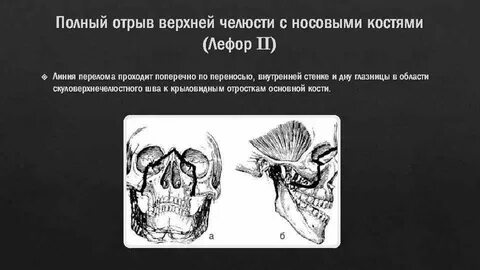 Перелом крыловидного отростка