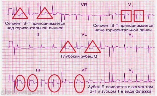 Инфаркт при низком давлении