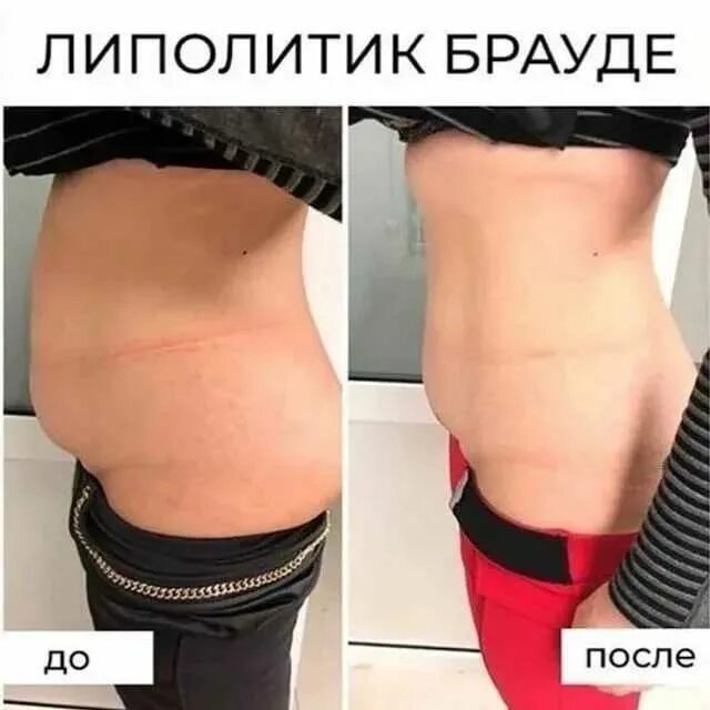 Липолитики что это. Липолитики. живот после липолитиков. до и после липолитиков живот.