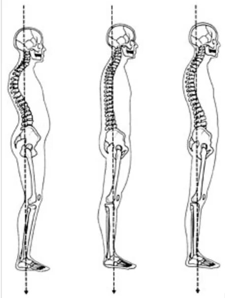 Сколиоз позвоночника таза. Искривление позвоночника перекос таза. Сколиоз позвоночника перекос таза. Искривление позвоночника скелет. Прямой позвоночник без изгибов