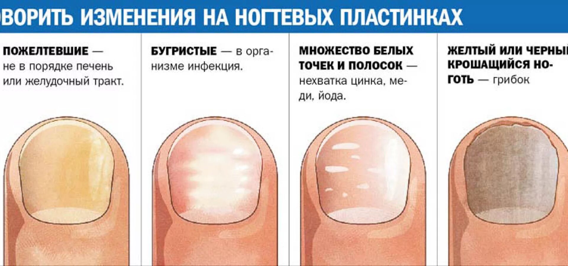 Во сколько формируется ногтевая пластина у девочек. Деформация ногтевой пластины. Изменение ногтевой пластины. Деыормация ногтеврй поасиины.