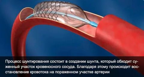 Шунтирование это простыми словами
