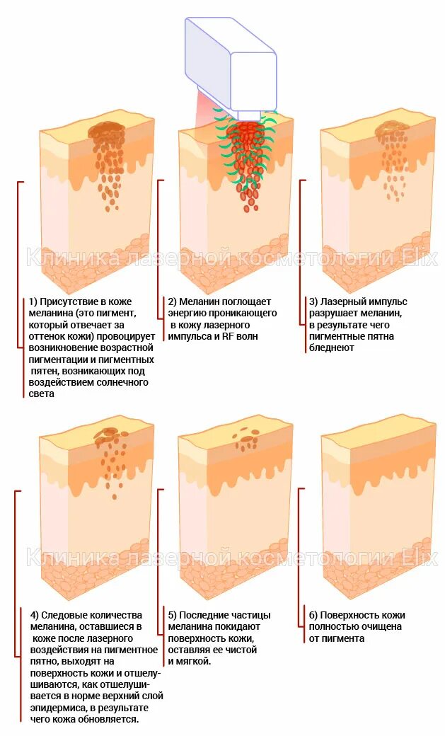 Разрушение пигментов. Меланин схема кожи. Воздействие лазера на пигмент. Воздействие лазера на кожу. Лазерное устранение пигментов на коже.
