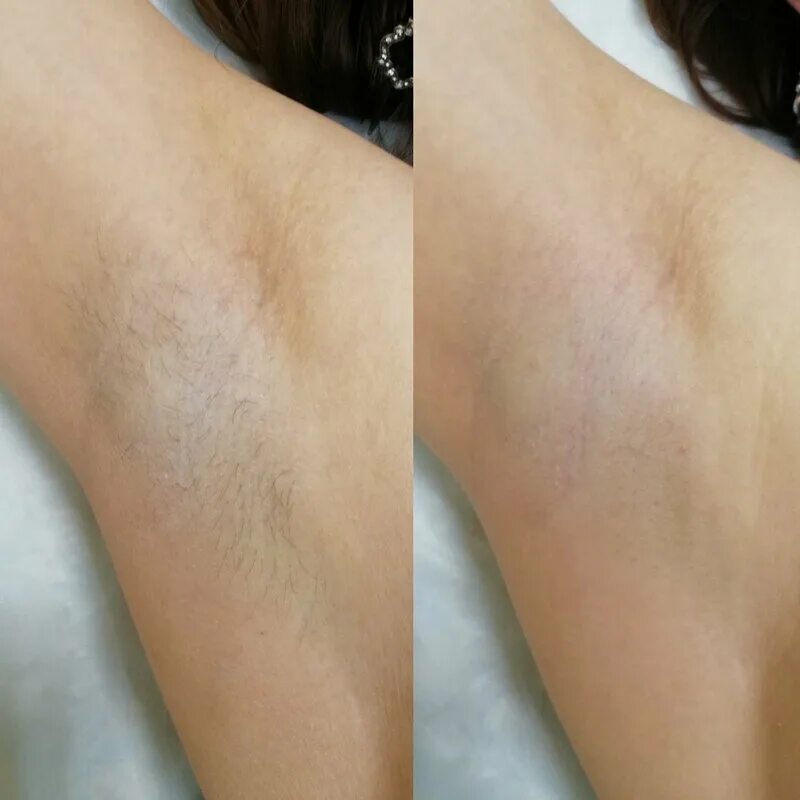 Подмышки после депиляции. Депиляция воском подмышки. Восковая депиляция. Подмышки после депиляции. Депиляция.