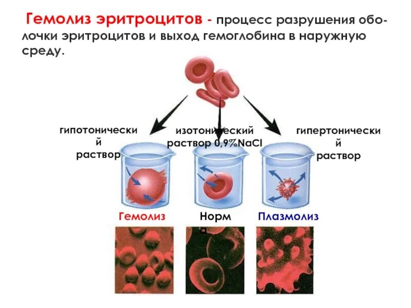 Гемолиз 3. Этапы гемолиза эритроцитов. гемолиз разрушение эритроцитов. причины осмотического гемолиза эритроцитов. гемолиз эритроцитов происходит в растворе.