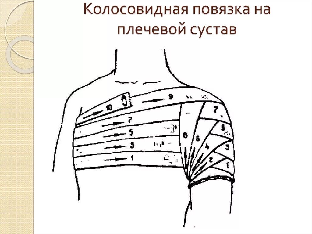 Плечевая повязка алгоритм. Наложение колосовидной повязки на плечевой сустав. Технику наложения колосовидной повязки на плечо. Десмургия повязка колосовидная на плечо. Алгоритм наложения бинтовой повязки на плечевой сустав.