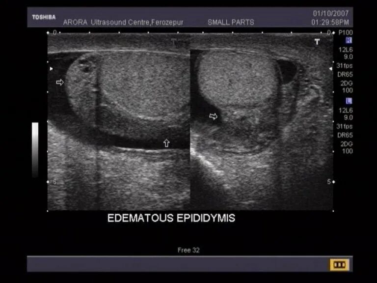Эпидидимит придатка яичка. Эпидидимит УЗИ признаки. Признаки хронического эпидидимита на УЗИ.