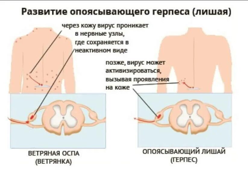 Почему образуются узлы. Герпес опоясывающий герпес. Герпес опоясывающий лишай.