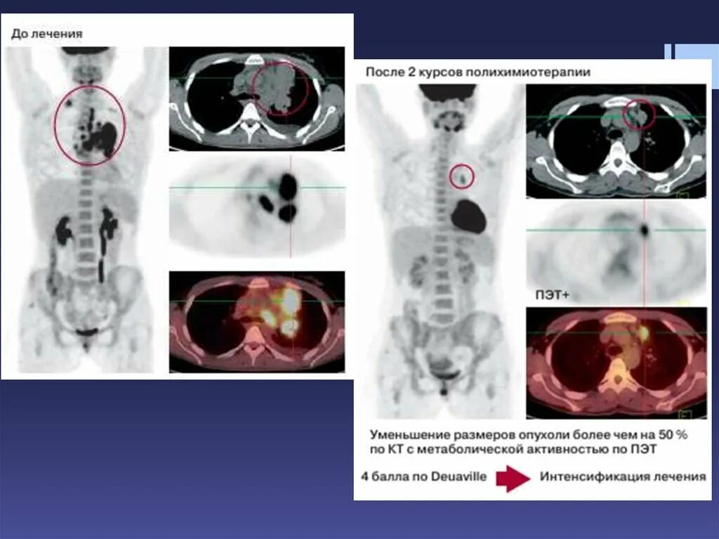 Диагностика лимфом презентация. Метаболической активности опухоли ПЭТ. Шкала активности опухоли на ПЭТ кт. Метаболическая активность что это на ПЭТ кт. Метаболическая активность на пэт