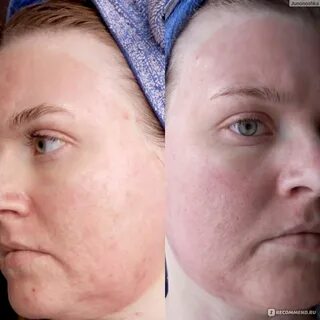 Лазерная шлифовка кожи skinlift
