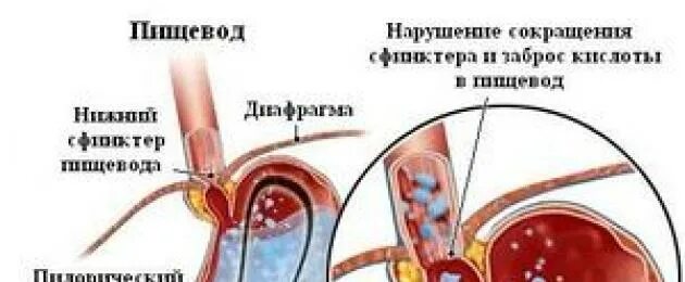 Выброс желчи во сне. Заброс кислоты из желудка в горло. Выброс желудочного сока в гортань. Заброс из желудка в гортань. Заброс желудочного сока в горло.