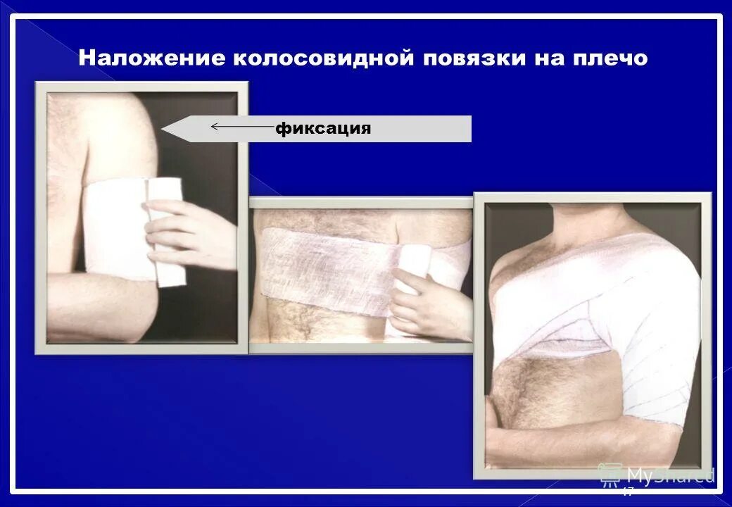 Алгоритм наложения колосовидной повязки. Колосовидная повязка применяется для перевязки. наложение колосовидной повязки на плечо. колосовидная повязка на плечевой. десмургия повязки на грудную клетку.