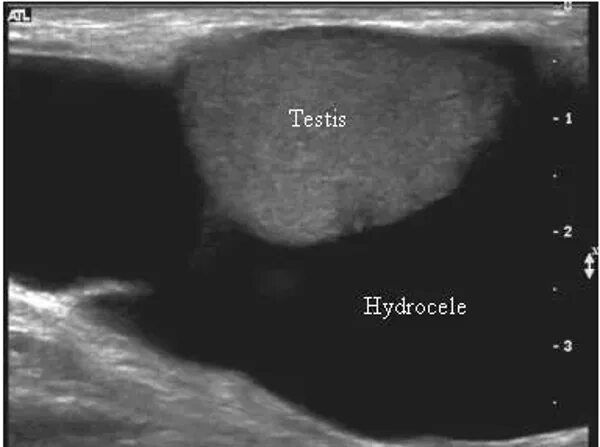 Увеличено яичко у мальчика. Жидкость в оболочках яичка на УЗИ. Водянка оболочек яичка УЗИ. УЗИ органов мошонки гидроцеле.