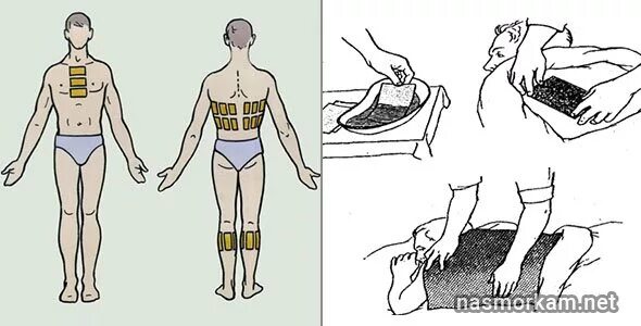 Сколько можно ставить горчичники взрослому. Постановка горчичников при кашле. Постановка горчичников на грудную клетку. Схема постановки горчичников при пневмонии. Места постановки горчичников при бронхите.