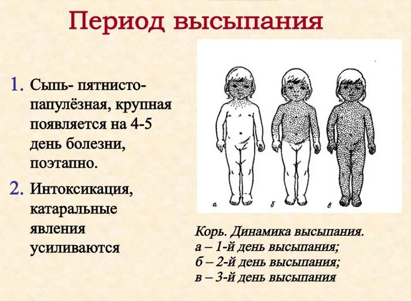 Корь симптомы и лечение. Этапы появления сыпи при кори. Этапность сыпи корь краснуха. Признак характерный для сыпи при кори. Этапы возникновения сыпи при кори.