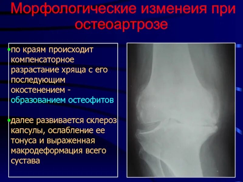 Остеофиты что это такое и как лечить. Остеофит по рентген коленного сустава. Костные разрастания в суставах.