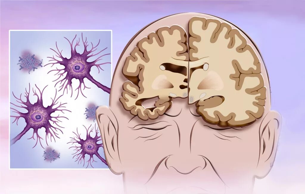 Мозг слабоумие. Хвороба Альцгеймера. Болезнь Альцгеймера иллюстрация.