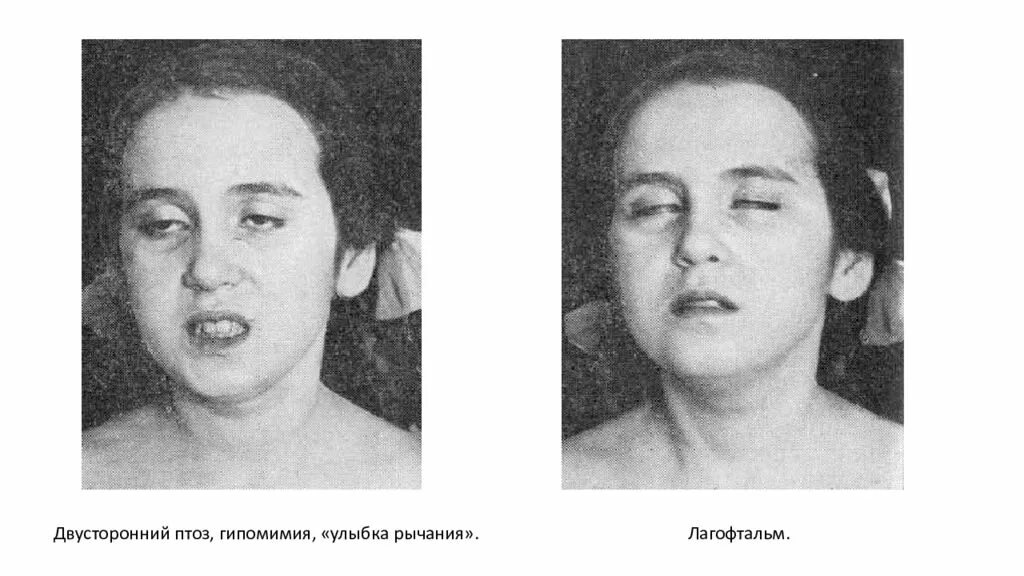 Горизонтальный парез взора. Центральный гемипарез поражение. Миастения бульбарная форма. Миастения генерализованная форма. Парез лицевого нерва и тройничного.