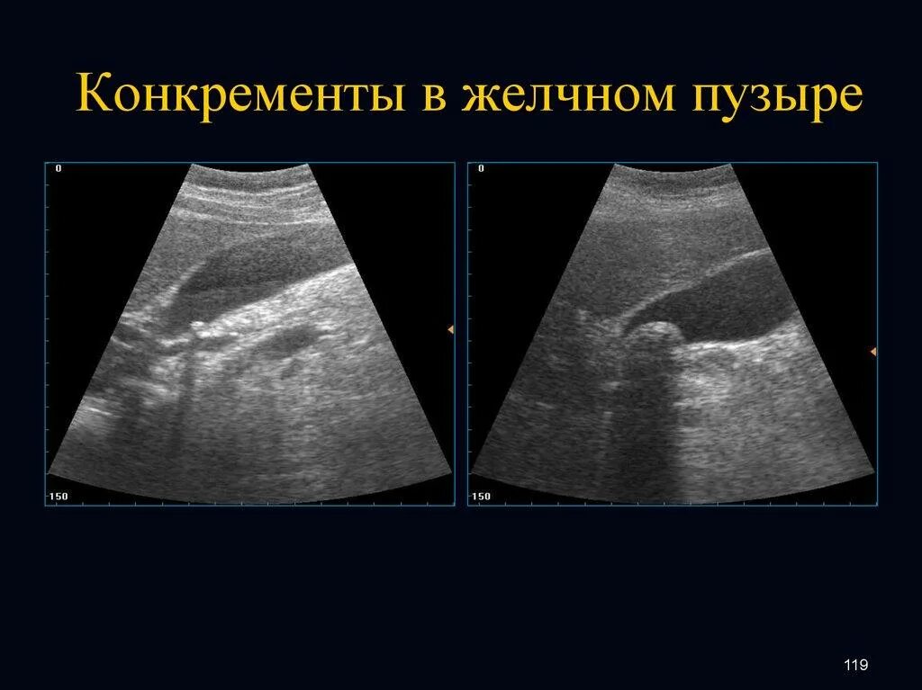 Какие симптомы при камнях в желчном. Узи камень в желчном пузыре 1,5см. конкременты желчного пузыря узи. ультрасонография желчного пузыря камни. ультразвуковая анатомия желчного пузыря.
