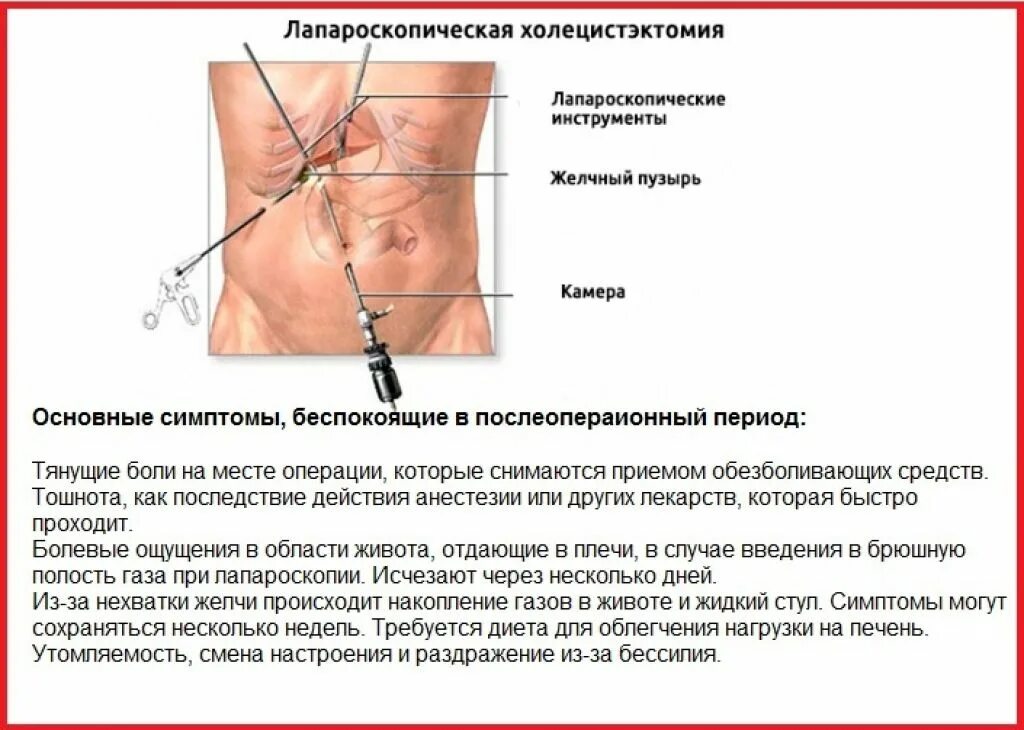 Питание после удаления желчного после года. Удаление желчного пузыря полостная операция. Рекомендации для пациента после холецистэктомии. Холецистэктомия диета. Диета в послеоперационном периоде после холецистэктомии.