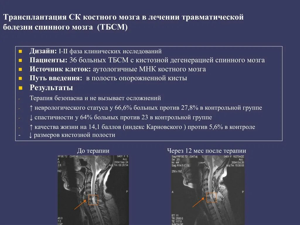 Травматическая болезнь спинного мозга. Трансплантация спинного мозга. Травматических повреждений спинного МОЗ. Пересадка костного мозга что это