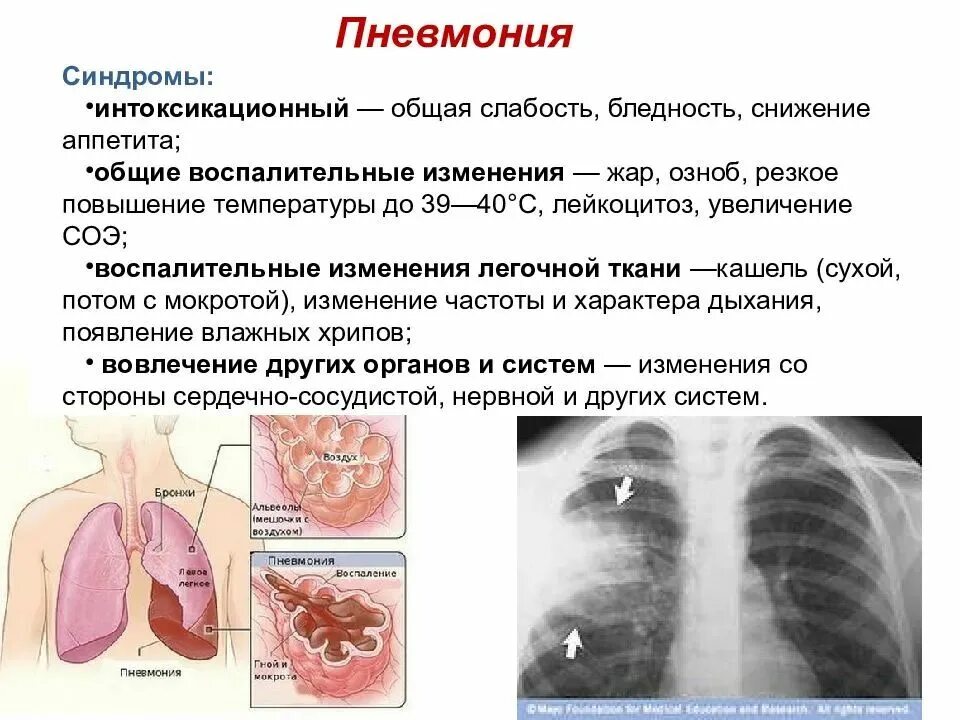 Признак воспаления легких у взрослых с температурой. Заболевания органов дыхания. Забооеванияорганов дыхания. Сообщение о заболеваниях органов дыхания. Заболевания органов дыхательных путей.