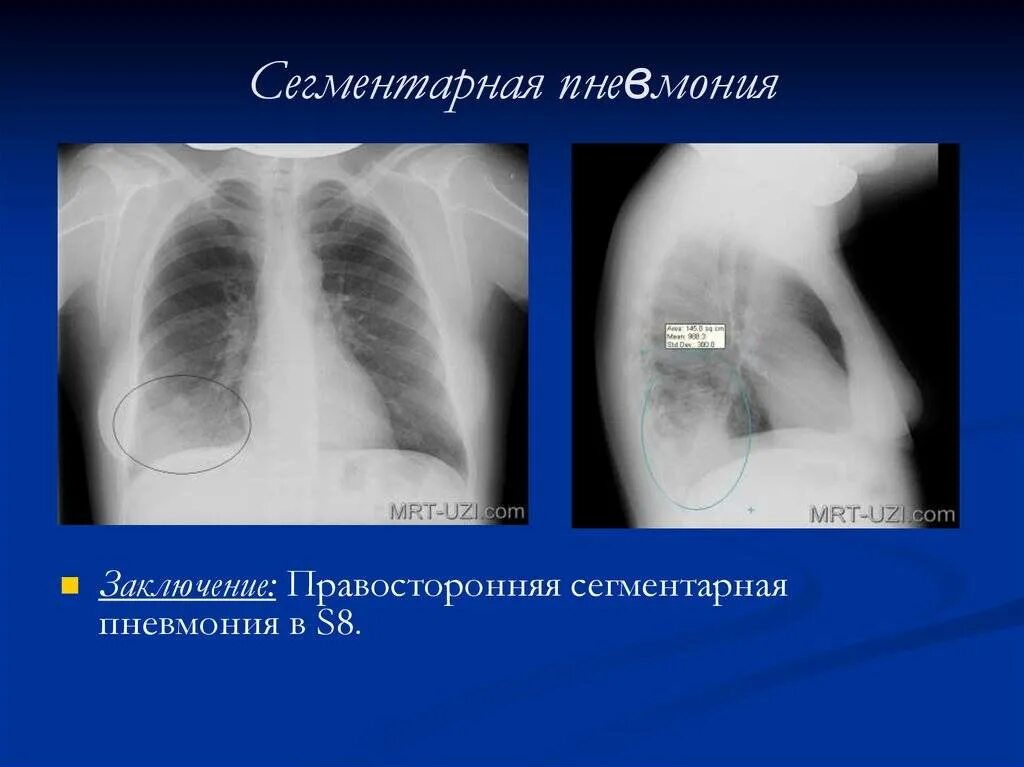 Что значит сегментарная пневмония. Сегментарная пневмония рентген. правосторонняя нижнедолевая пневмония 10 сегмент. левосторонняя полисегментарная пневмония рентген. s10 сегмент левого легкого пневмония.