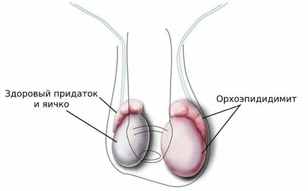 У мужчины болят яички причины и лечение. Острый орхоэпидидимит. Заболевания яичек у мужчин.