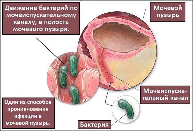 Воспаление мочевого пузыря. Микроорганизмы в мочевом пузыре.