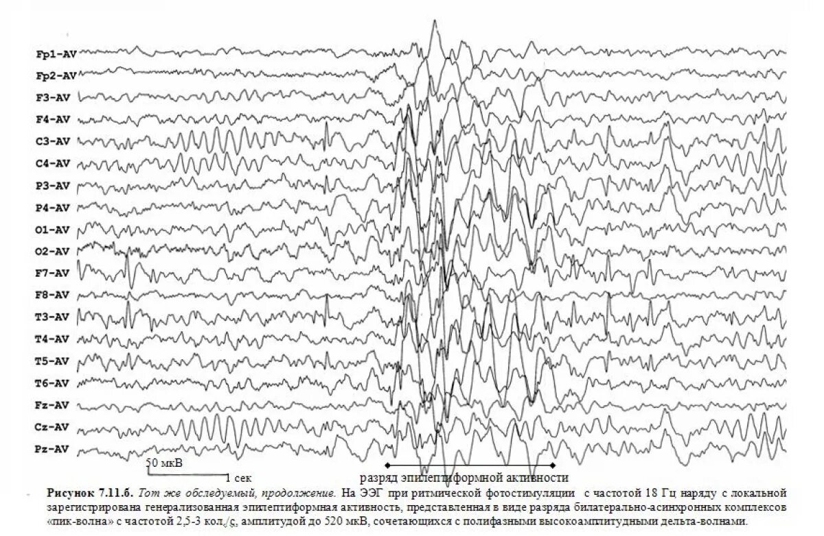 Плохое ээг. ЭЭГ энцефалограмма эпилепсия. Иктальный паттерн на ЭЭГ при эпилепсии. ЭЭГ показатели больного эпилепсией. ЭЭГ при эпилепсии расшифровка.