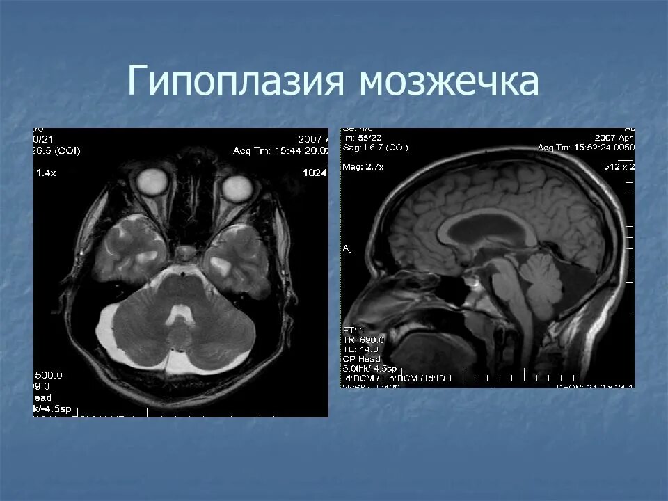 Гипотрофия червя мозжечка на мрт. Гипоплазия червя мозжечка. Мозжечок на мрт в норме. Недоразвитие головного мозга. Гипоплазия правых синусов