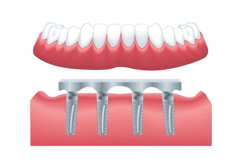 Цвет виниров а1. Цвет зубов. Естественный цвет зубов. Шкала вита а1 диоксид. Цвет зубов а3.