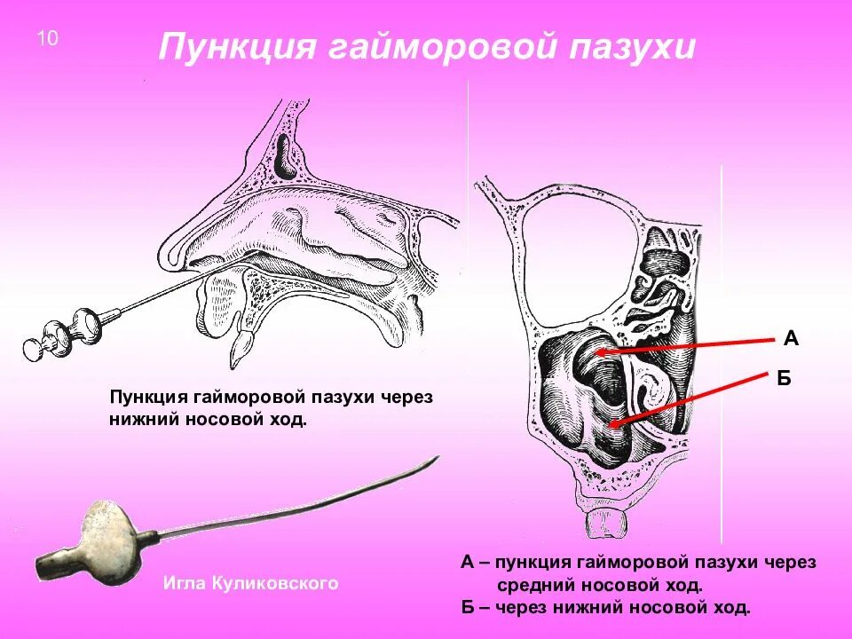 После прокола гайморовой. Пункция гайморовой пазухи техника. Прокол гайморита верхнечелюстной пазухи. Пункция при одонтогенном гайморите. Инструмент для пункции гайморовой пазухи.