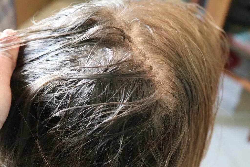 Фолликулярный педикулез. Гниды вшей на волосах фото. Гниды вшей на волосах фото. Гниды вшей на волосах фото. Гниды вшей на волосах фото.