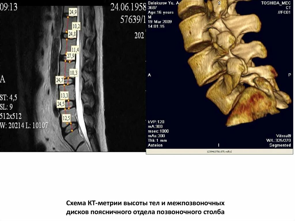 Остеохондроз поясничного отдела l5 s1. Высота межпозвоночных дисков снижена с6-с7. Снижение высоты межпозвоночного диска. Снижение высоты межпозвонковых дисков. Снижена высота межпозвоночных дисков что это.