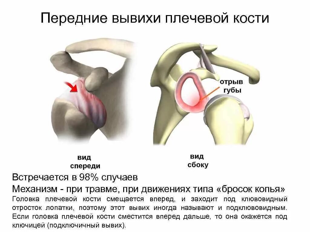 Механизмы травмы вывиха плечевого сустава. Механизм вывиха головки плечевой кости. Подвывих плече лучевогосустава. Закрытый вывих головки плечевой кости. Повреждения правого плечевого сустава