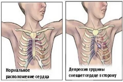 Щелкает грудина