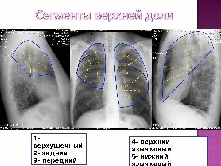 Сегмент s9 правое легкое. Язычковые сегменты легких рентген. 10 Сегмент правого легкого рентген. Долевое строение легких рентген. S8 левого легкого