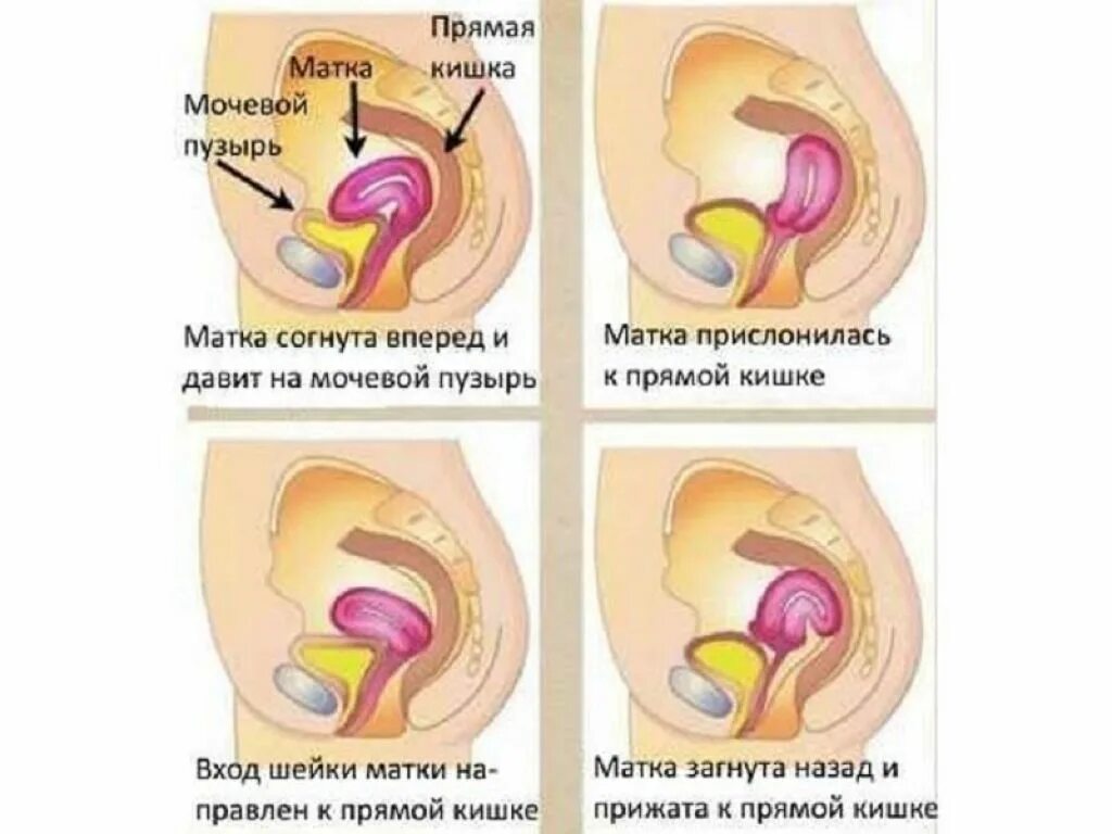 Шейка матки отклонена кзади. Расположение шейки матки кзади. Ретроверсия матки. Положение матки. Изгиб шейки