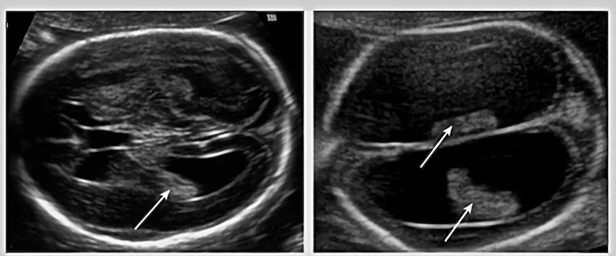 Нейросонография вентрикуломегалия. Вентрикуломегалия плода на УЗИ. Вентрикуломегалия головного мозга у плода. Гидроцефалия нейросонография. Расширение боковых рогов