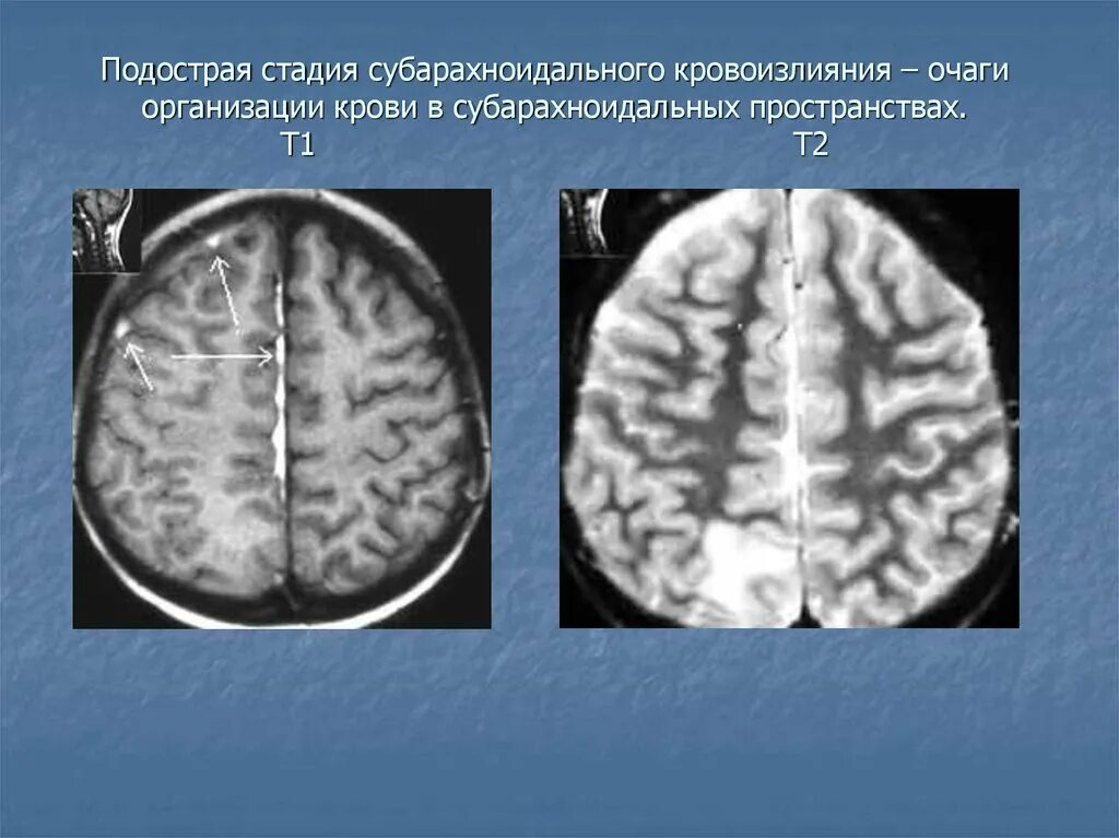 Паренхиматозно-субарахноидального кровоизлияния. Травматическое субарахноидальное кровоизлияние кт. Эпидуральная гематома головного мозга. Кт при субарахноидальном кровоизлиянии. Субарахноидально-паренхиматозное кровоизлияние.